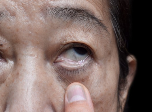 “Ferritin Face” Is Trending—But Can Your Skin Really Reveal Low Iron?