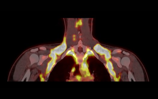 Why Activating Brown Fat to Treat Obesity is So Hard