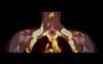 Why Activating Brown Fat to Treat Obesity is So Hard