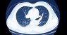 Loss of Bone Mineral Density Linked to Cognitive Decline