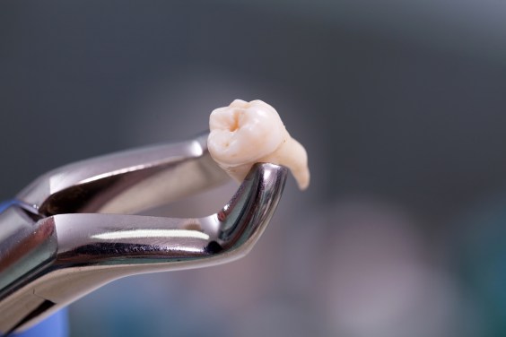 First Case of Teeth Growing Out of an Eye Socket